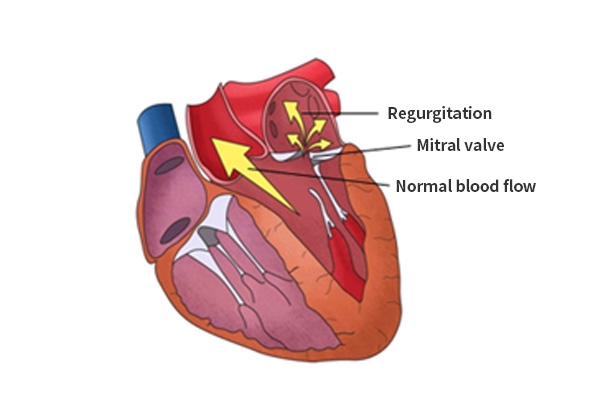 Mitral Loop Cerclage