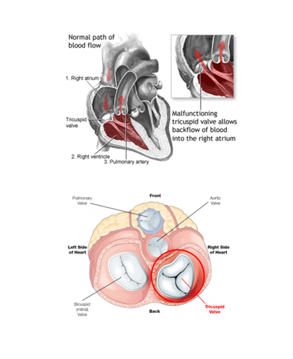 Mitral Loop Cerclage