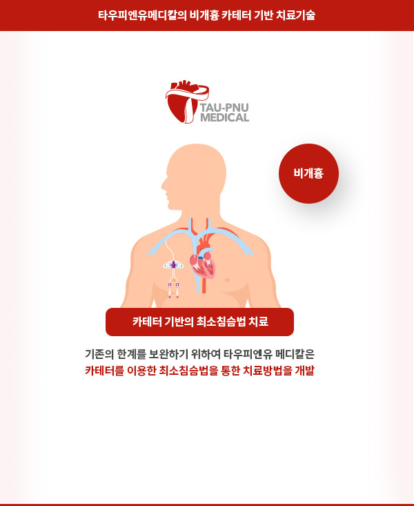 타우피엔유메디칼의 비개흉 카테터 기반 치료기술